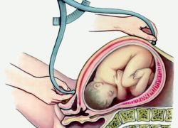 kako razumjeti položaj longitudinalnog fetusa
