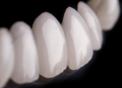 подреждане на зъбите с осветителни тела