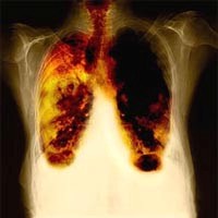 Etapy raka płuc