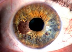 příznaky melanomového oka