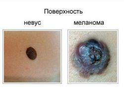 Moles melanoma kože