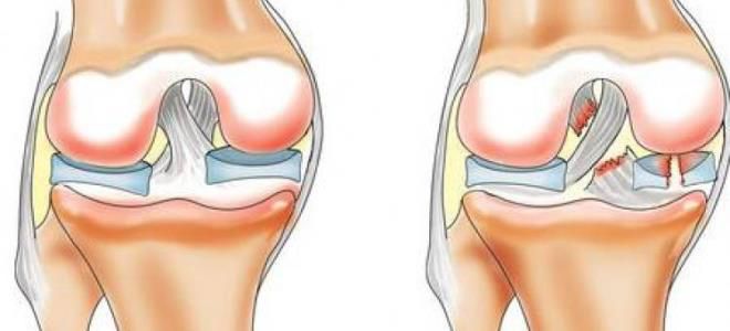 травма колена разрыв мениска