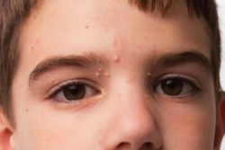 školjke na koži kod djece