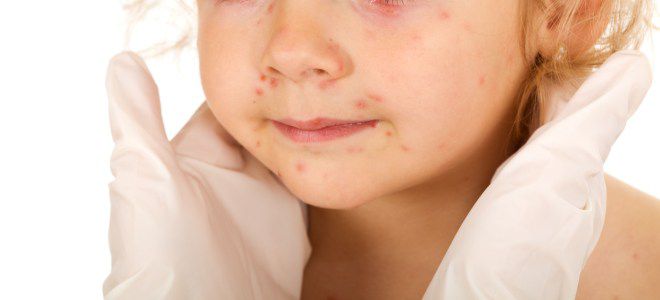 Сыпь при мононуклеозе у детей