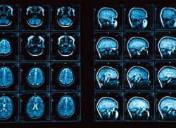 Badanie MRI naczyń mózgowych