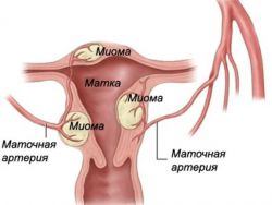maternične fibroide, katere velikosti so nevarne