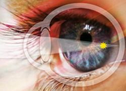 Blaga miopija oka