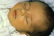 neonatalna zlatenica novorojenčkov