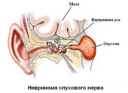 Akustični neuroma tumor slušnega živca