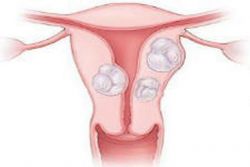 děložní fibroidní forma
