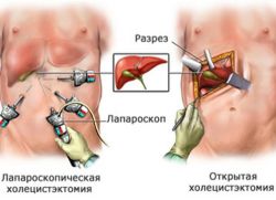 хирургия за отстраняване на жлъчката