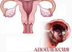 Příčiny prasknutí vaječníků u žen