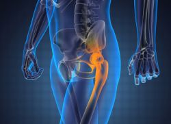 bol u zglobovima kuka prilikom hodanja uzrokuje vitamina i liječenje osteoartritisa