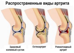 болест зглобова ногу