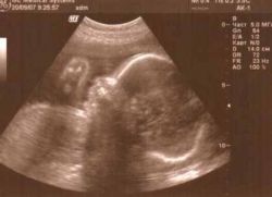 první fetální srdeční tep na ultrazvuku