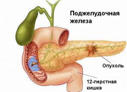 příznaky rakoviny pankreatu