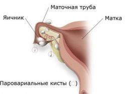 Paraovariální cystová léčba