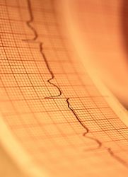 Napadowy częstoskurcz na EKG