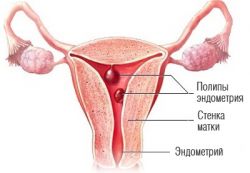polip polipa endometrium