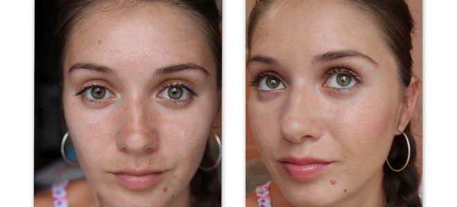 фотоомоложение лица до и после