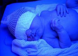 fyziologické žloutenky léčby novorozenců