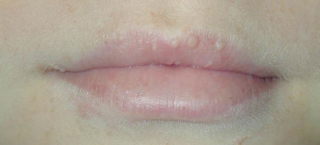 бели пимпле на усни