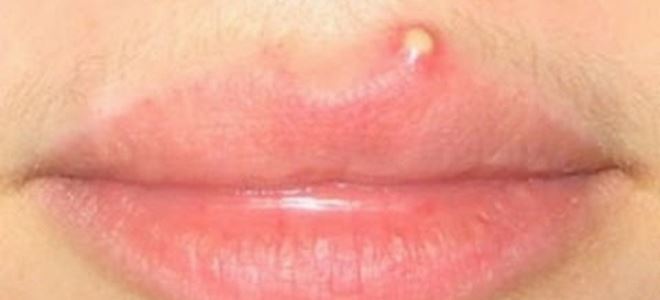 purulent pimple na ustnici