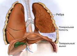 Wysiękowe zapalenie opłucnej w onkologii