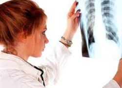 léčba plicní fibrózy