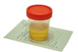 beljakovine za analizo urina v nosečnosti