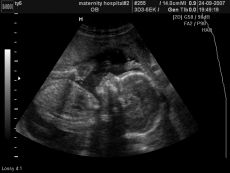 fetusa u 20 tjedana trudnoće