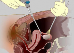 nosečnost po laparoskopiji