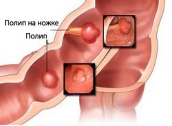 Nosečnost po odstranitvi endometrijskega polipa