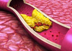 pripravki za čiščenje krvnih žil iz holesterola