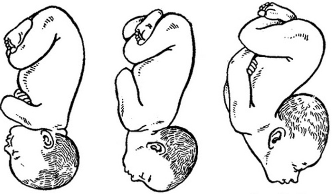 předčasného plodu během těhotenství1