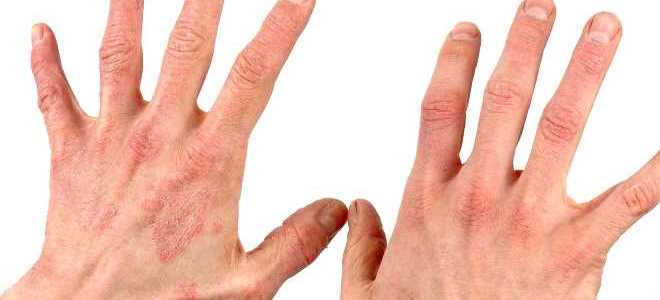 симптоми на псориазис върху ръцете
