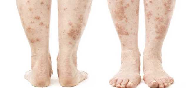симптоми на псориазис в краката