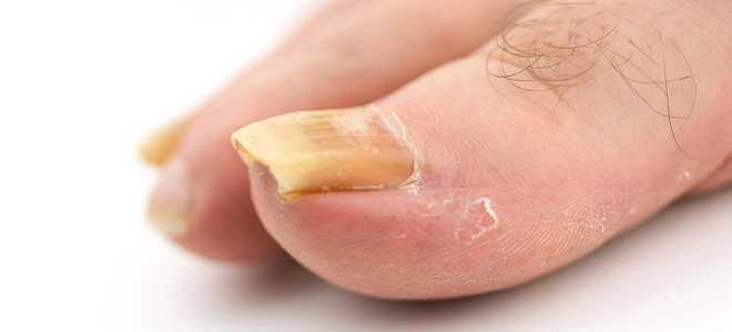 objawy łuszczycy paznokci