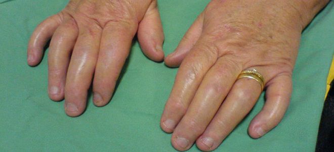 Naselja liječenje artritisa i artroze u Irkutsk regiji