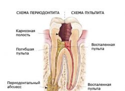 Pulzirajoča bolečina v zobu pod polnjenjem