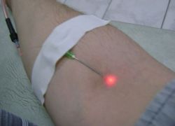 lasersko čiščenje krvi