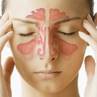 simptomi purulentnega sinusitisa