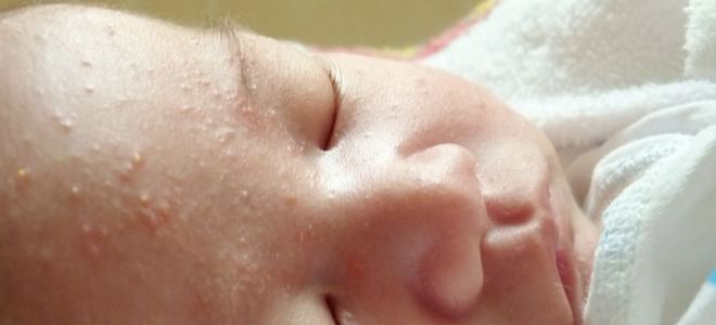 Гормональная сыпь у новорожденных вид