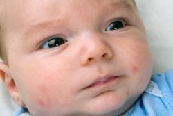 alergijski osip u novorođenčadi