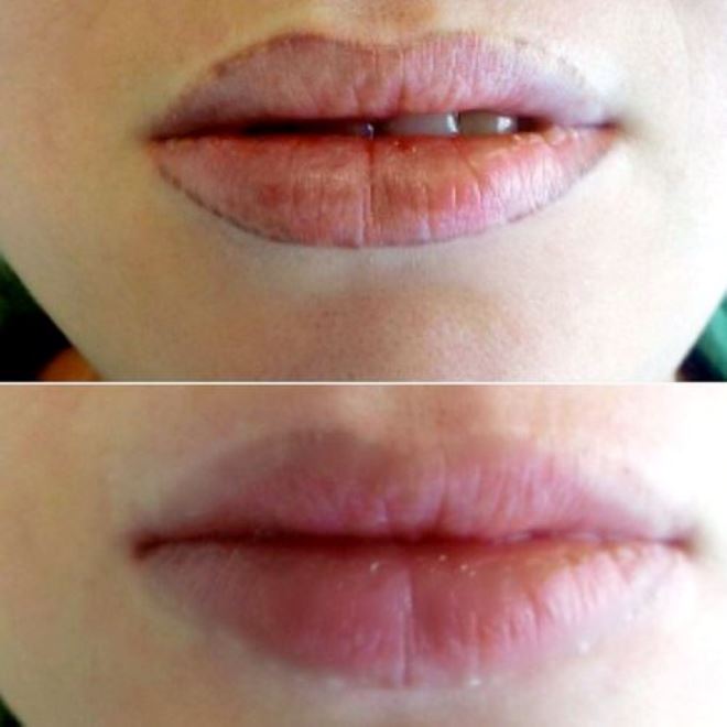 odstranjevanje ustnic laserskega tattoo-a (2)