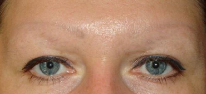 odstranitev odstranjevanja očesnih tatojev2