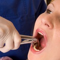 отстраняване на зъбния корен без болка