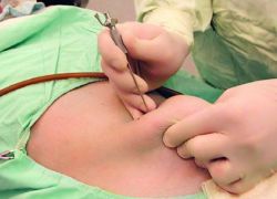 metode uklanjanja fibroida maternice