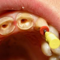 obnova zuba s iglom