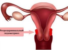 cervikální endometrióza